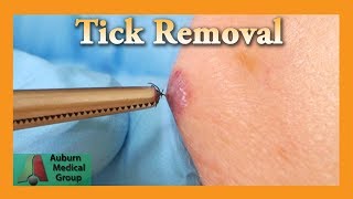 Dead Tick Removal  Auburn Medical Group [upl. by Alic]