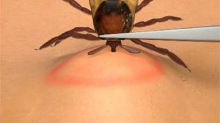 How To Remove A Tick [upl. by Trebbor]