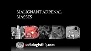 Malignant Adrenal Masses [upl. by Aira]