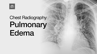 Chest Radiography Pulmonary Edema [upl. by Daveda]