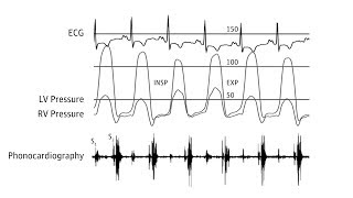 Myocarditis  causes pathophysiology investigation and treatment [upl. by Ancelin]