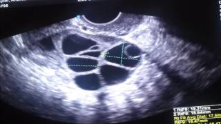 The HIER Egg Retrieval Method Helped a 48YearOld Patient Get Pregnant at CHR [upl. by Yrtnahc409]