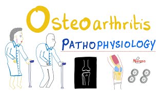 Osteogenesis Imperfecta  Causes Symptoms Treatment [upl. by Witte]