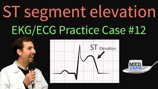 ST Elevation  EKG  ECG Interpretation Case 12 STEMI MI ACS [upl. by Trahern]