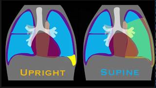 Pleural Effusion Explained by Prometheus Lionhart MD [upl. by Anegal]