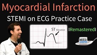 Myocardial Infarction  STEMI on ECG  Practice EKG [upl. by Kinch]