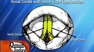 Vocal Cord Dysfunction [upl. by Yelrebmyk]