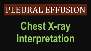 Pleural Effusion  Chest Xray Interpretation [upl. by Verne]