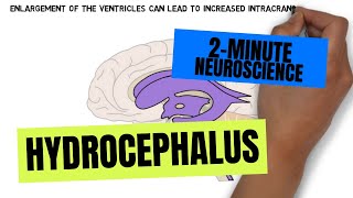 2Minute Neuroscience Hydrocephalus [upl. by Lexa]