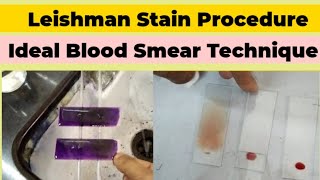 Leishman Stain Procedure and Blood Smear Preparation for DLC Count [upl. by Zorah882]