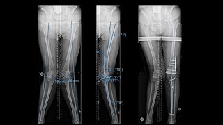 Knieprothese  Nachbehandlung amp Reha  Dr med Markus Weber [upl. by Angus]