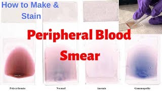 Peripheral Blood Smear Peripheral Smear Examination  Leishmans Staining Procedure [upl. by Gabrielson]