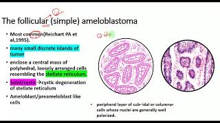 Odontogenic Keratocyst Clinical features Radiology Histology and Treatment [upl. by Herrera410]