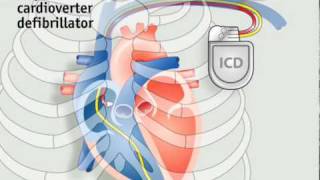 How pacemakers work [upl. by Nuawaj]