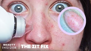 Pore Vacuum For Blackheads Has BuiltIn Microscope  The Zit Fix [upl. by Obie]