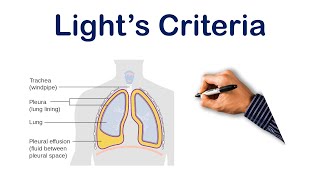 Pleural Effusion Lights Criteria  USMLE STEP COMLEX NCLEX [upl. by Gearalt]