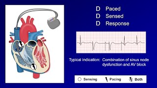 Pacemaker Modes and Settings [upl. by Airdnekal]