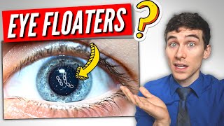 3 Must Know Facts About EYE Floaters [upl. by Akla]