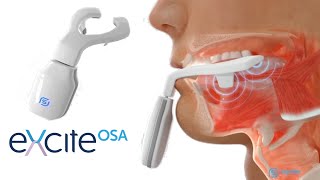 eXciteOSA  Daytime Treatment for Mild OSA and Snoring FDA Approved Sleep Therapy Device [upl. by Kwarteng]