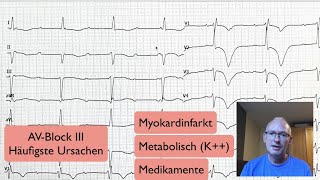 EKG Quickie AVBlock [upl. by Ollayos]