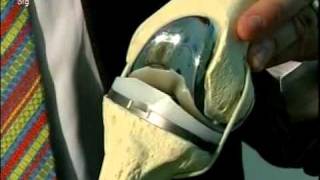 Knee Replacement Surgery  Minimally Invasive Surgery with Dr Richard Berger [upl. by Tterrab]