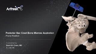 Posterior Iliac Crest Bone Marrow Aspiration  Prone Position [upl. by Anivahs57]