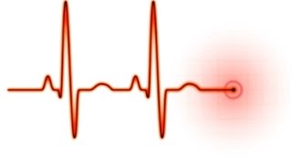 Easy EKG STEMI [upl. by Larochelle]