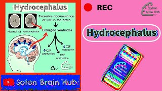 Hydrocephalus [upl. by Deedee]