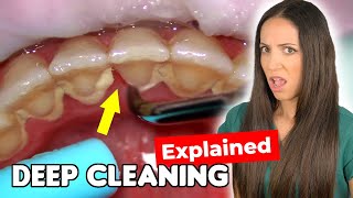 Dental Hygienist Explains Deep Cleaning Procedure [upl. by Ditzel840]