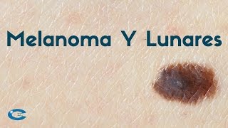 Melanoma y lunares en la piel [upl. by Ayra]