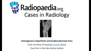 Mastering the 3 Os of Arthrodesis in Spine Surgery A Simple Analogy to Understand Fusion [upl. by Endres]