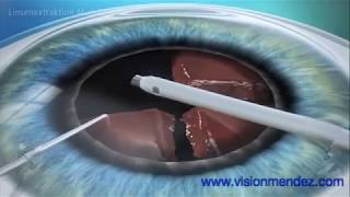 Implante de Lente intraocular Multifocal [upl. by Kylynn]